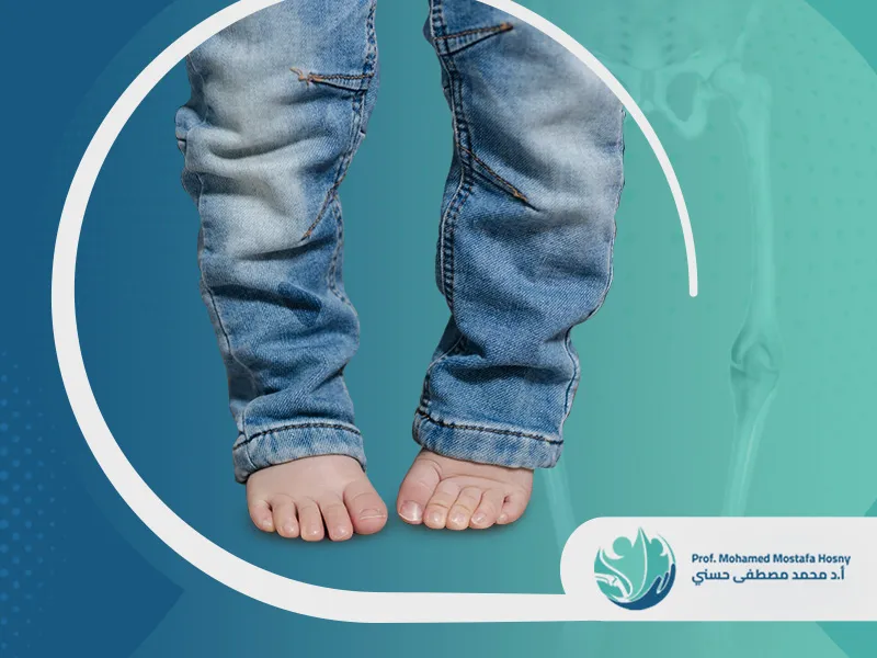 خيارات علاجية متنوعة لحالات التقوس عند الأطفال