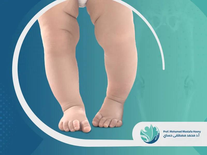 شكل-تقوس-الساقين شكل تقوس الساقين عند الأطفال: الأنواع والأسباب