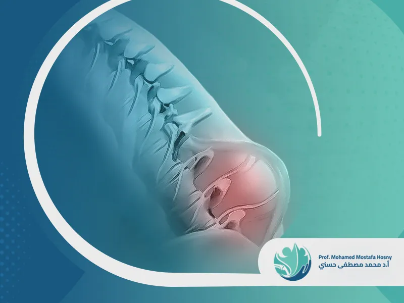 علاج-الصلب-المشقوق علاج الصلب المشقوق