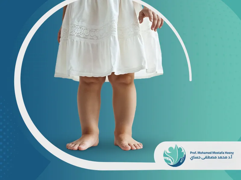 كيف يمكن علاج تقوس الساقين عند البنات؟