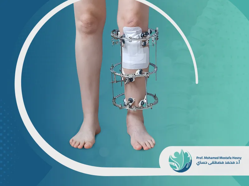 عملية-استعدال-تقوس-الساقين عملية استعدال تقوس الساقين للأطفال: تعرف على تقنياتها والحالات المُرشحة
