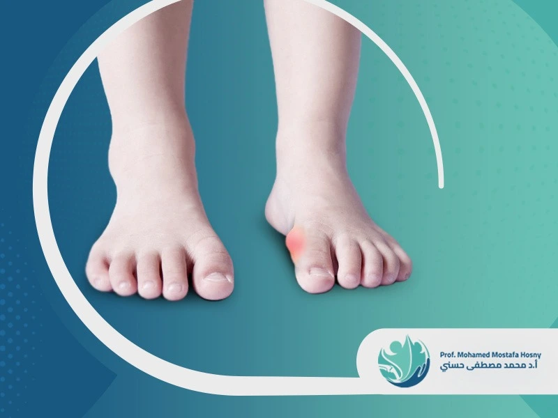 بروز عظمة القدم عند الأطفال