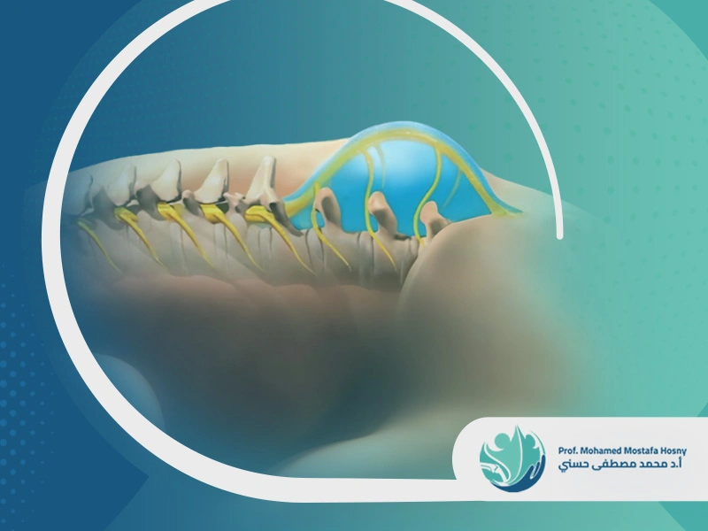 السنسنة المشقوقة