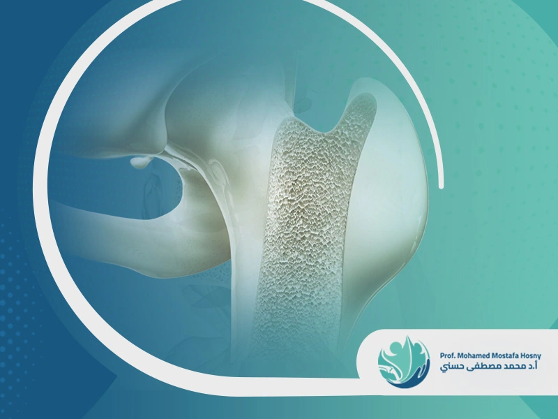 هشاشة العظام